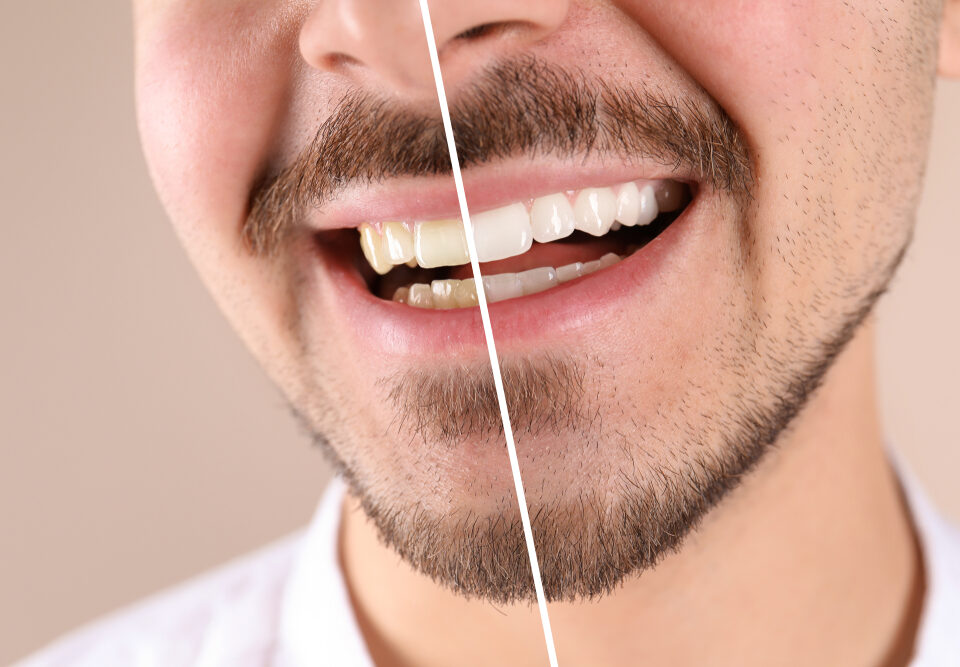 Teeth Whitening: In-Office vs. At-Home Kits, Which Is Right for You?